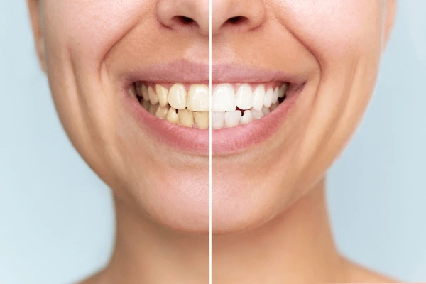 teeth whitening in vancouver