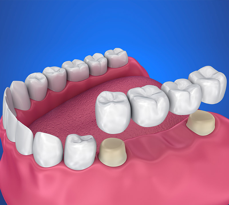 dental bridges in vancouver
