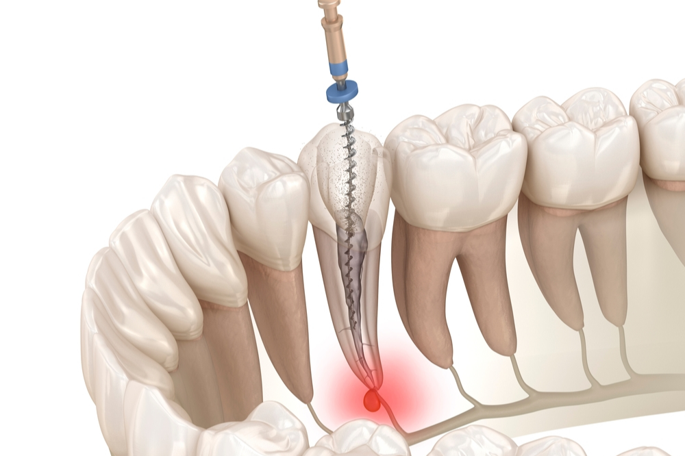 Root Canal Procedure for Infected Tooth Nerve