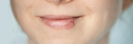 same day cold sore laser treatment in vanocuver